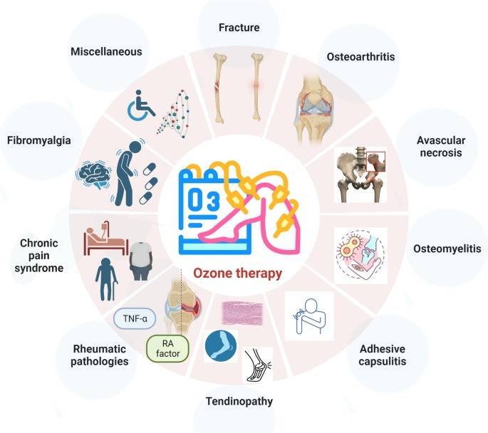 Terapia con ozono | Centro Eos